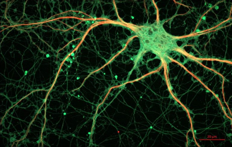 Colesterol no cérebro está associado a surgimento da doença de Alzheimer, diz estudo
